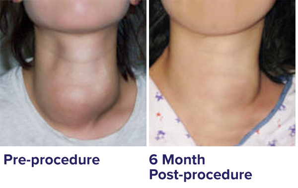 Before and after 6 month photo in which bulge is significantly reduced