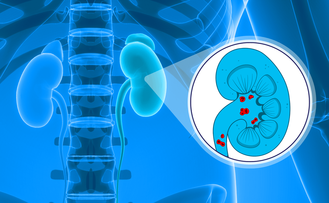 kidney stones